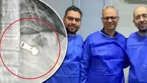 نجاح استخراج جسم معدني من معدة طفلة بمستشفى دسوق العام..بلعت سوستة