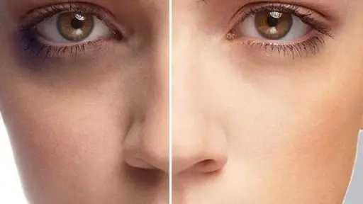 وصفات طبيعية لتفتيح منطقة العين